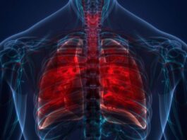 World TB Day is on March 24.